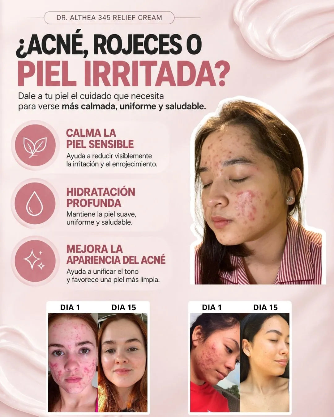 Crema 345 – Calma el Acné y Mejora tu Piel